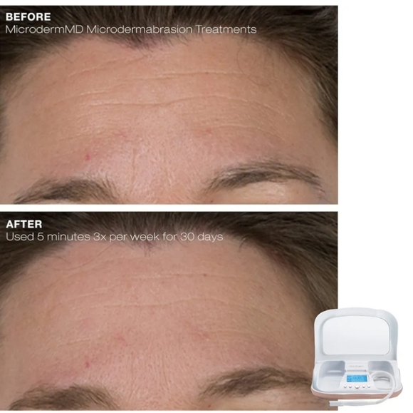 TROPHY SKIN Microderm MD Dermabrasion System. NEW & SEALED. - Picture 8 of 16